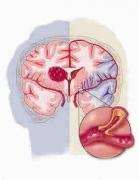Síntomas de un ataque cerebral